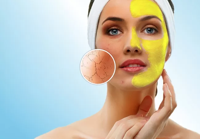 Say No To Acne With Turmeric