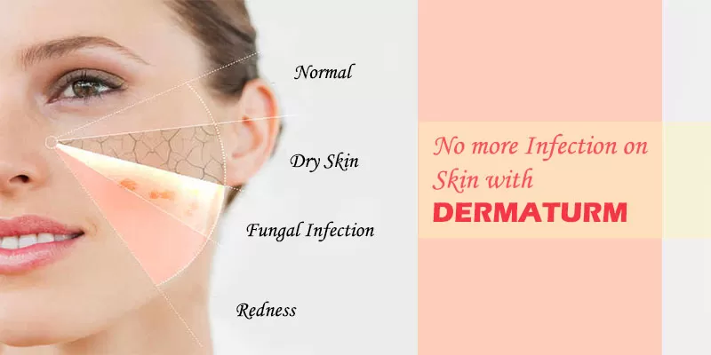 dermaturm helps in fungal infection organically