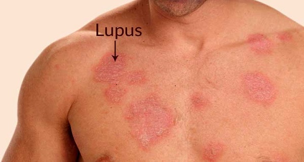 ImmunoTurm for curing lupus naturally