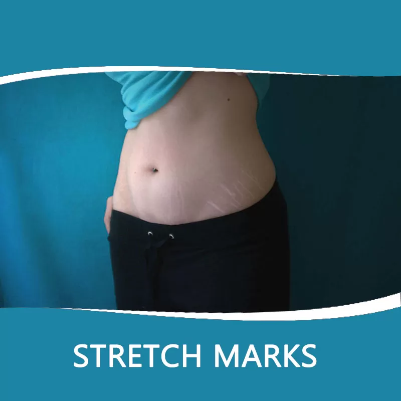 dermaturm for stretch marks removal