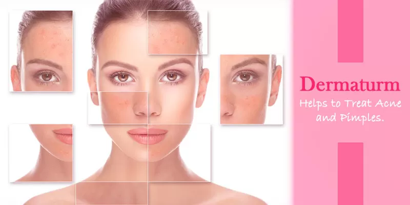 Get rid of Acne & Pimples with Dermaturm