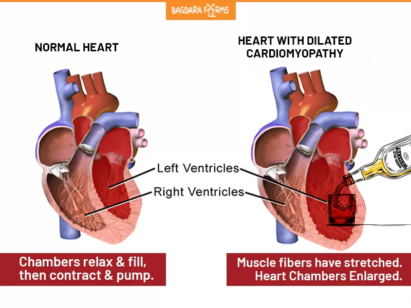 Alcohol Consumption Could Lead To Alcoholic Cardiomyopathy?