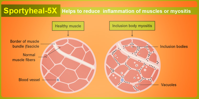 Sportyheal-5X treatment for muscle inflammation