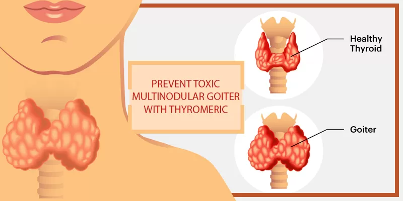 Study proves Curcumin can Help in Toxic Multinodular Goiter
