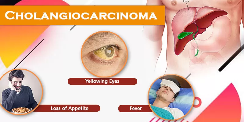 Curcumin Comes To The Rescue In Case Of Cholangiocarcinoma – Rare Form Of Cancer