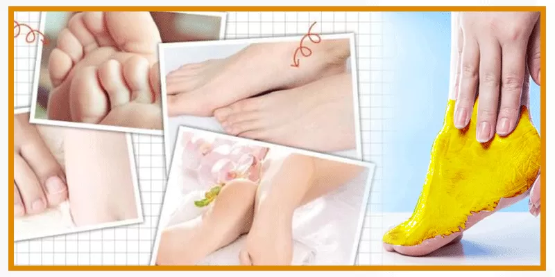 Fighting Toenail Fungus With Curcumin