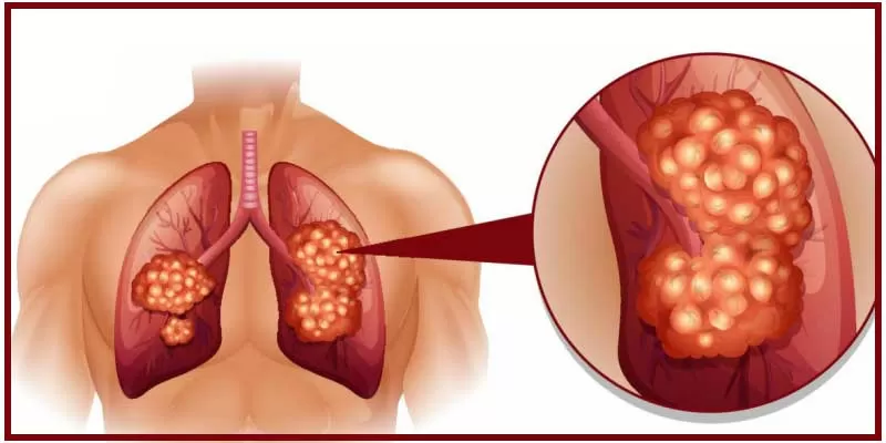 Can Lung Cancer Patients Rely On Curcumin Lessen Their Agony?