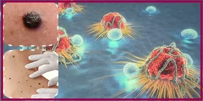 skin cancer for treatment with turmeric