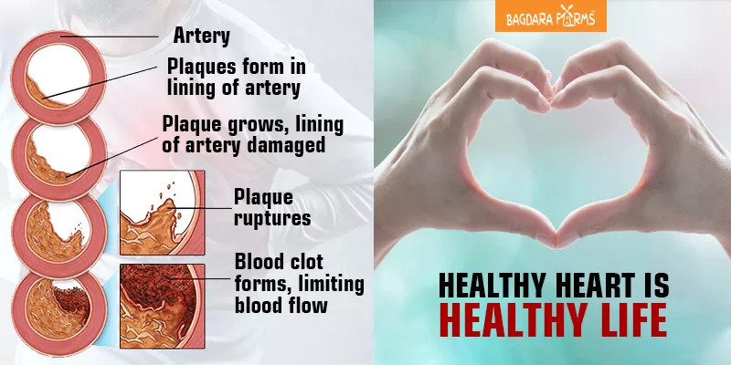 ह्रदय के लिए खतरनाक है एथेरोस्क्लेरोसिस (Atherosclerosis), बचाव ही है उपाय