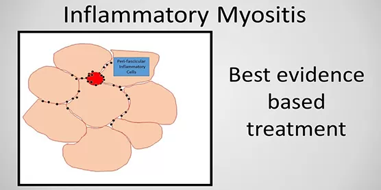 Treatment For Myositis 